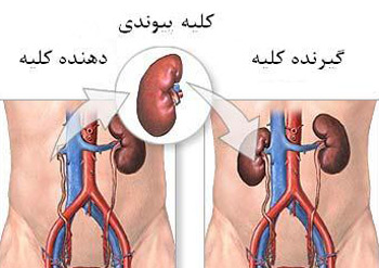 بیماری مزمن کلیه و درمان آن