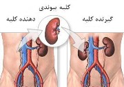 بیماری مزمن کلیه و درمان آن