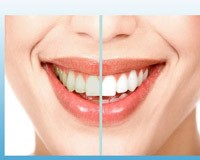 درمان زردی دندان با سفید کننده دندان اصل